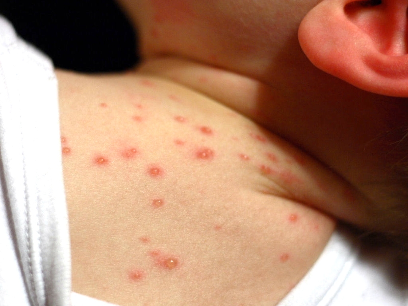Sự khác nhau giữa bệnh thủy đậu và sởi 1