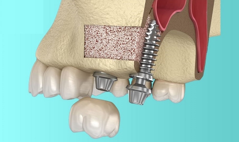 Sự khác nhau giữa nâng xoang kín và nâng xoang hở 2