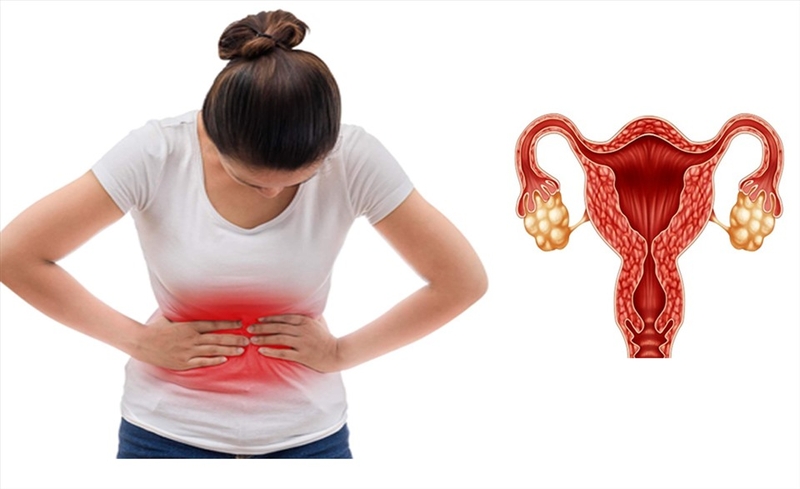 Sự thật về hội chứng buồng trứng đa nang 1