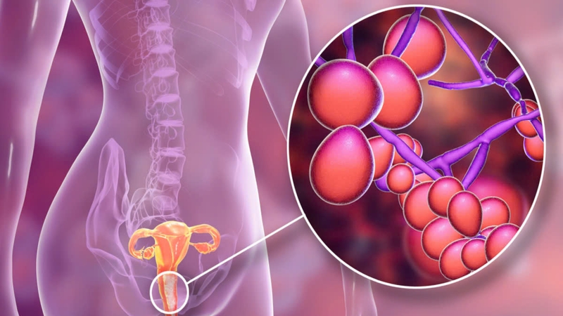 Sự thật về viêm bộ phận sinh dục nữ​ và cách phòng tránh hiệu quả 1