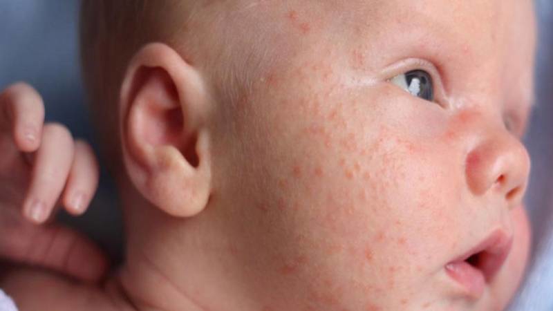 Bé bị chàm sữa bôi thuốc gì ? Cách chữa chàm sữa cho trẻ sơ sinh 2