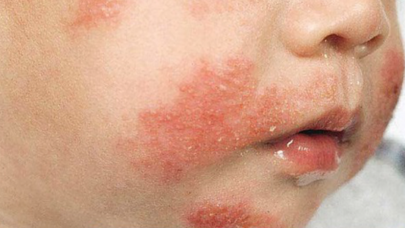 Tìm hiểu sữa Abbott Similac Isomil dành cho trẻ dị ứng sữa bò1