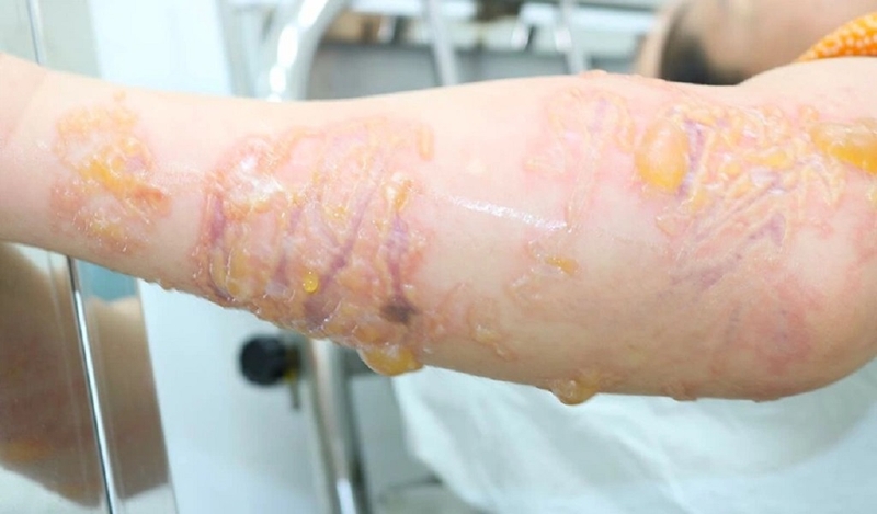 Sứa có độc không và cách sơ cứu khi bị sứa độc cắn 3