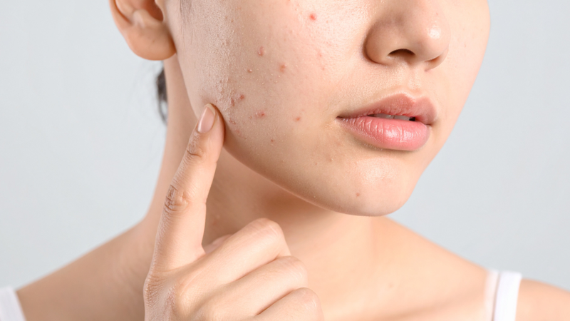 Sữa rửa mặt Cerave có đẩy mụn không?