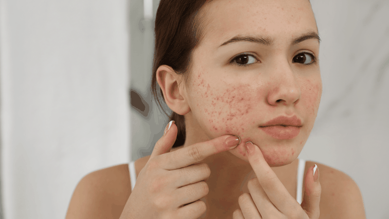 Da dầu mụn nên dùng vì khả năng làm sạch sâu, ngăn ngừa mụn rất hiệu quả