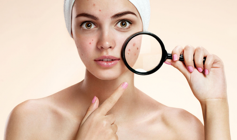 Sữa rửa mặt kiềm dầu cho da nhờn mụn có tốt không? 1