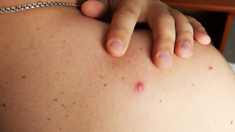 Sữa tắm trị mụn lưng: Giải pháp làm sạch và ngăn ngừa mụn từ gốc 2