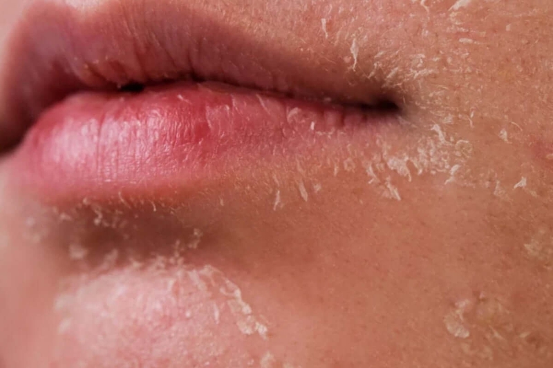 Sức khỏe da liễu: Chăm sóc da khô thế nào cho khoa học? 1