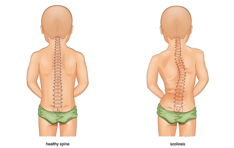 Sức khỏe: Phẫu thuật vẹo cột sống ở trẻ1