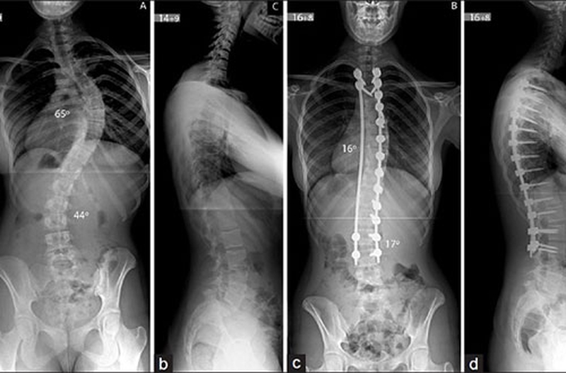 Sức khỏe: Phẫu thuật vẹo cột sống ở trẻ2
