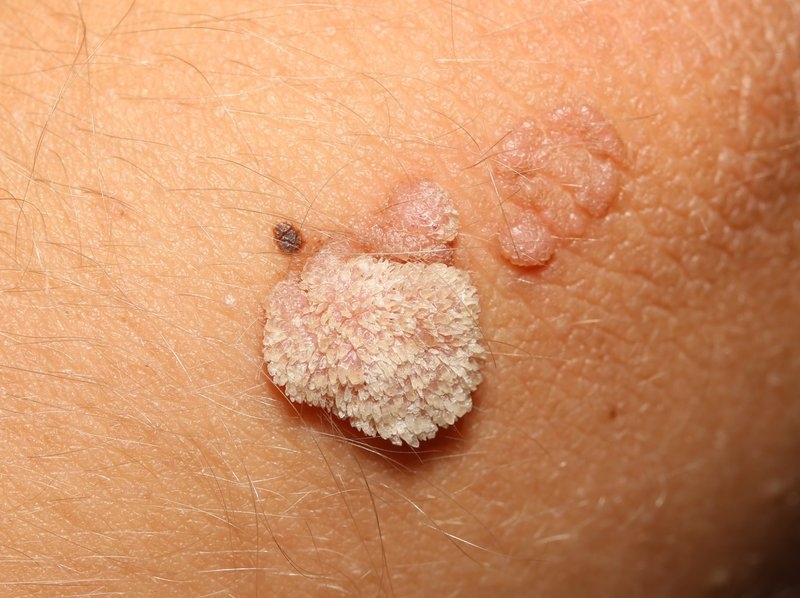 [Góc giải đáp] Sùi mào gà tự đào thải được hay không? 3