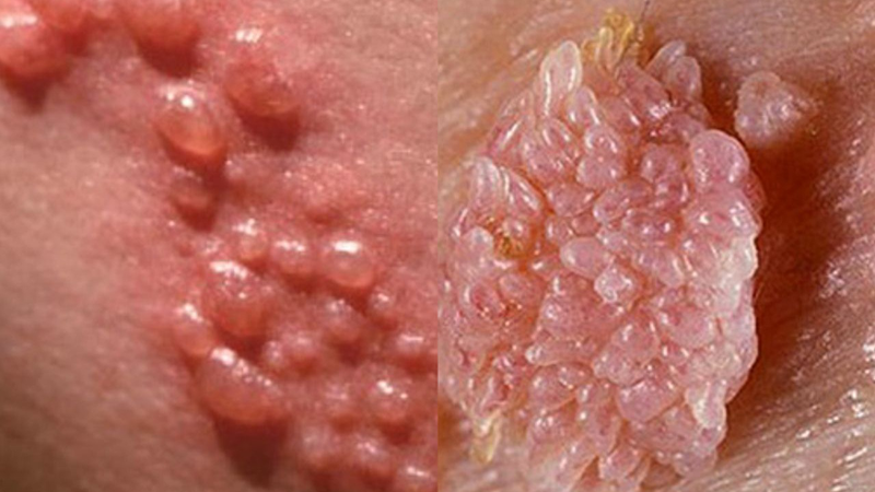 Sùi mào gà có gây ung thư không?-2