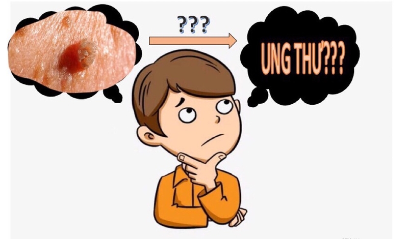 Sùi mào gà có gây ung thư không?-3