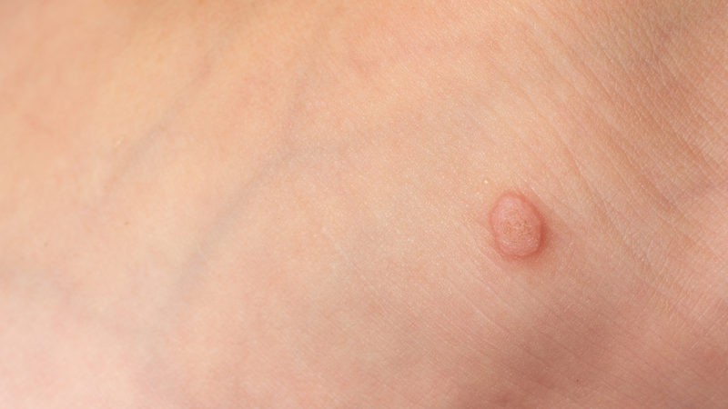 Sùi mào gà có ngứa không, hay đây là dấu hiệu của một bệnh lý khác