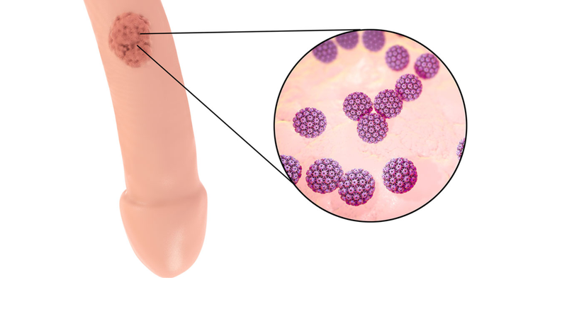 Sùi mào gà dương vật là gì? Cách điều trị và phòng ngừa sùi mào gà dương vật 4