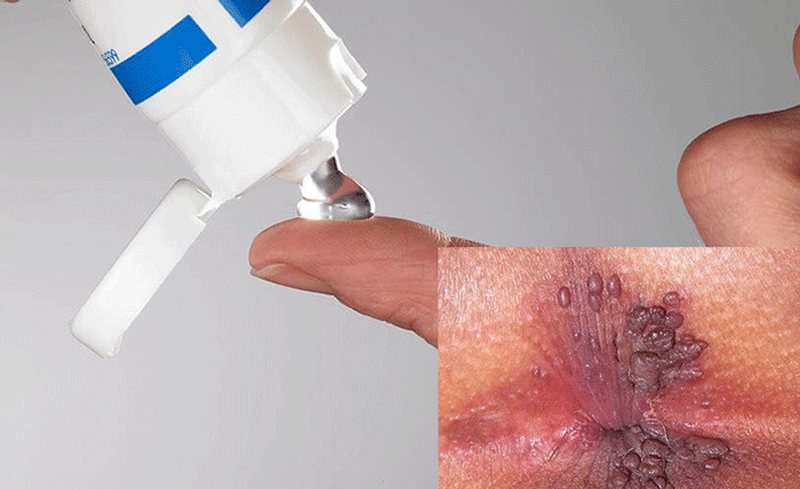 Sùi mào gà hậu môn: Làm thế nào để nhanh khỏi và cách phòng ngừa tái phát 3