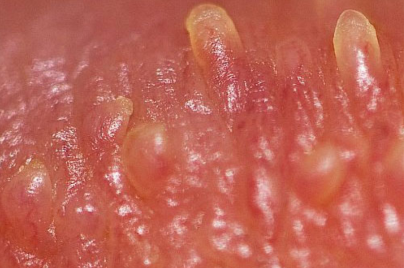 Sùi mào gà nữ gây ra bởi Human papilloma virus (HPV), còn được gọi là mụn cóc sinh dục