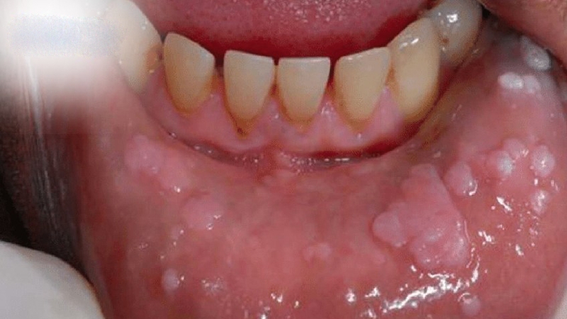 Sùi mào gà ở lưỡi giai đoạn đầu​ có nguy hiểm không? Những biến chứng nếu không điều trị kịp thời  5