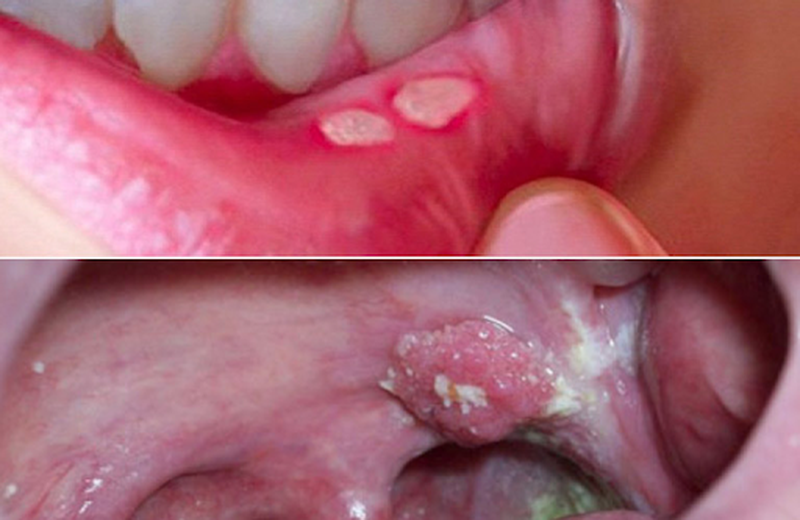 ùi mào gà ở miệng và nhiệt miệng ban đầu đều xuất hiện các nốt mụn li ti màu hồng hoặc trắng