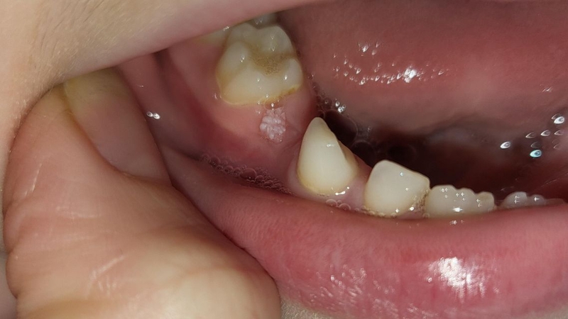 Sùi mào gà ở nướu răng: Nguyên nhân, dấu hiệu nhận biết và cách điều trị 1