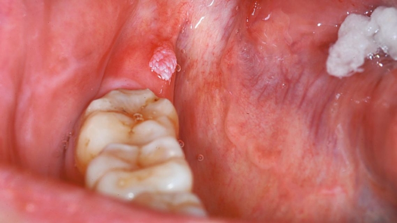 Sùi mào gà ở nướu răng: Nguyên nhân, dấu hiệu nhận biết và cách điều trị 2
