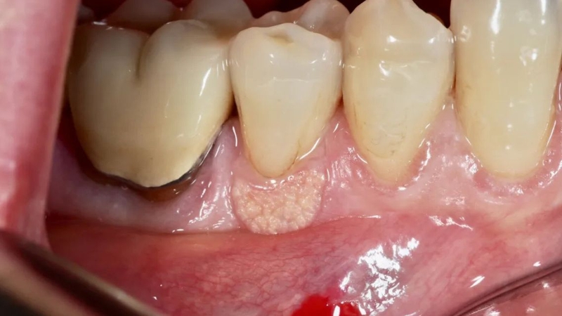 Sùi mào gà ở nướu răng: Nguyên nhân, dấu hiệu nhận biết và cách điều trị 3