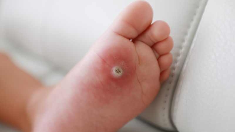 Sùi mào gà ở trẻ em lây qua đường nào? 2