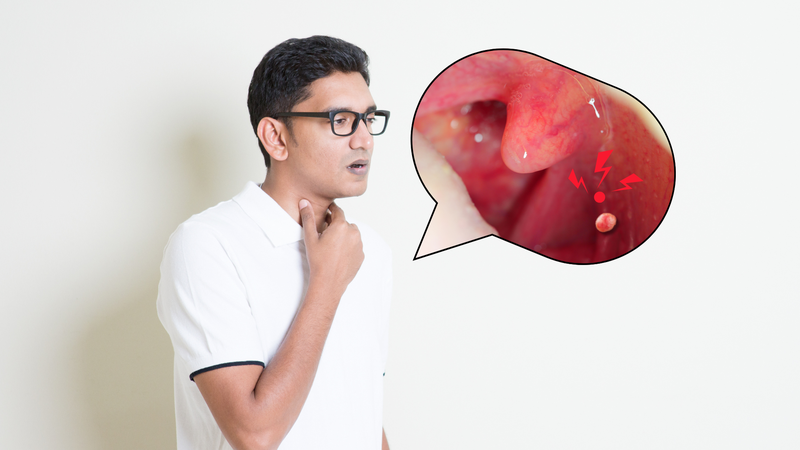 Sùi vòm họng ở người lớn: Nguyên nhân, triệu chứng và cách phòng ngừa hiệu quả 3