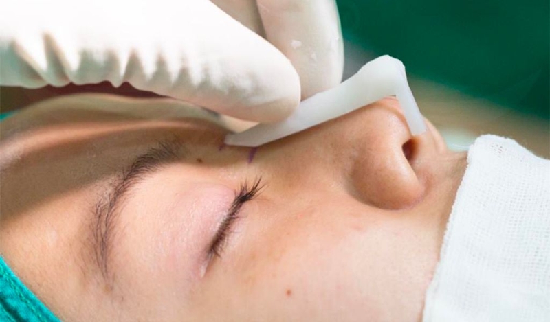 Sụn nâng mũi softxil là gì? Nâng mũi sụn Softxil có tốt và an toàn? 2