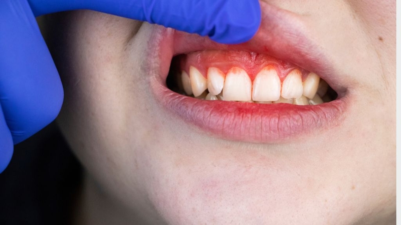 Sưng chân răng nên làm gì? 1