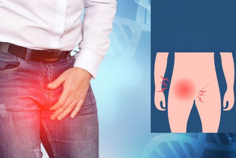 Sưng hạch bẹn: Nguyên nhân và cách điều trị 2