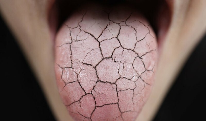 Sưng lưỡi là bệnh gì? Nguyên nhân và cách điều trị