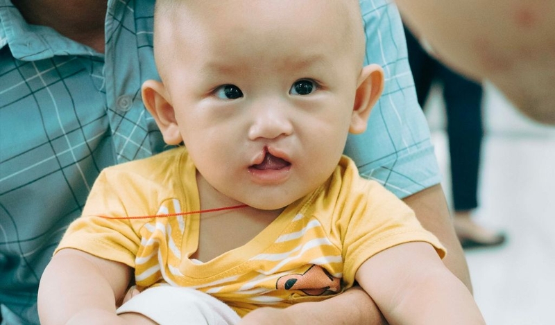 Sứt môi hở hàm ếch có di truyền không? Cách phòng ngừa 1