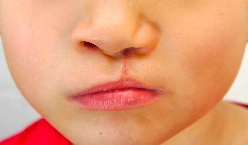 Sứt môi hở hàm ếch có di truyền không? Cách phòng ngừa 3