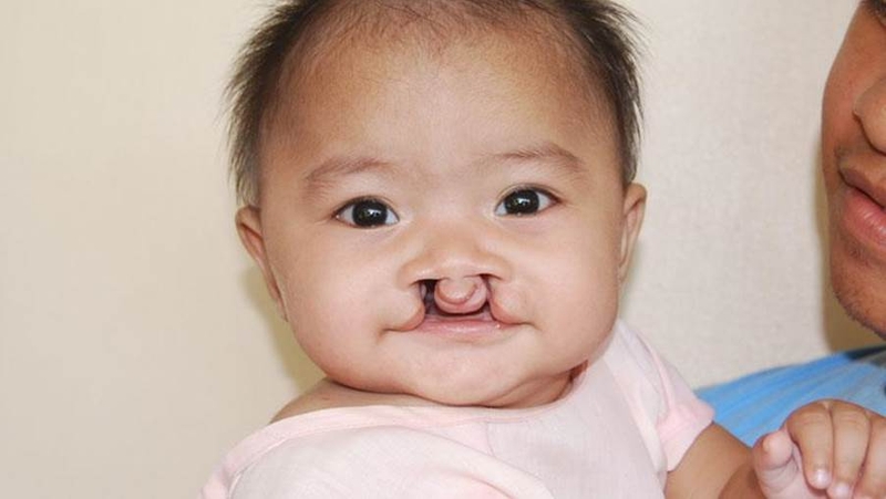 Sứt môi và hở hàm ếch là gì? Nguyên nhân, triệu chứng và cách điều trị 1