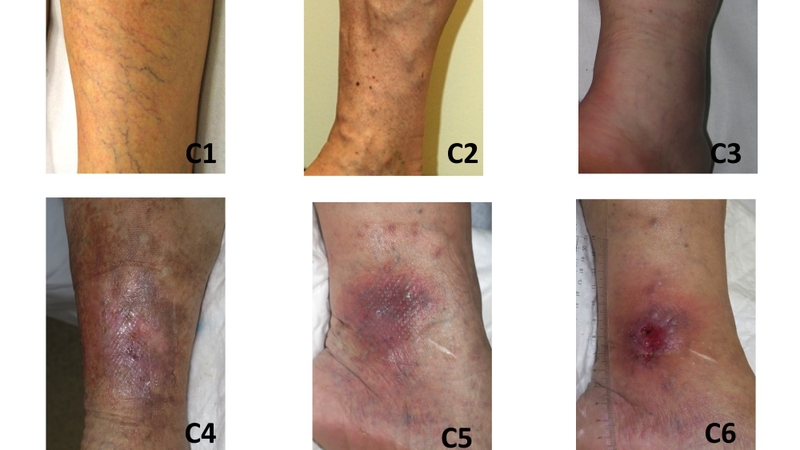 Suy giãn tĩnh mạch chi dưới: Bệnh lý phổ biến hiện nay 1.jpg