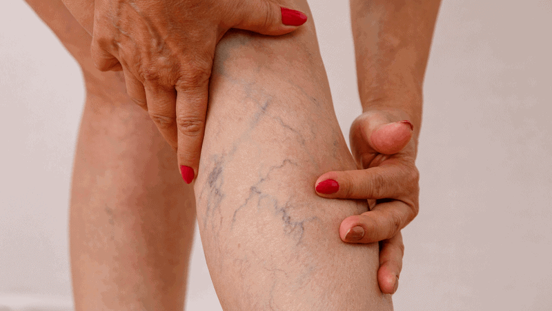 Suy giãn tĩnh mạch có di truyền không? Những điều cần biết 1