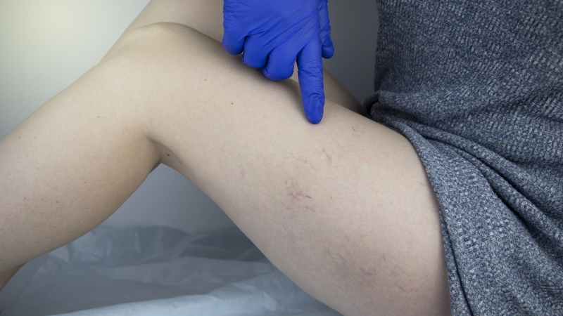 Suy giãn tĩnh mạch có di truyền không? Những điều cần biết 2