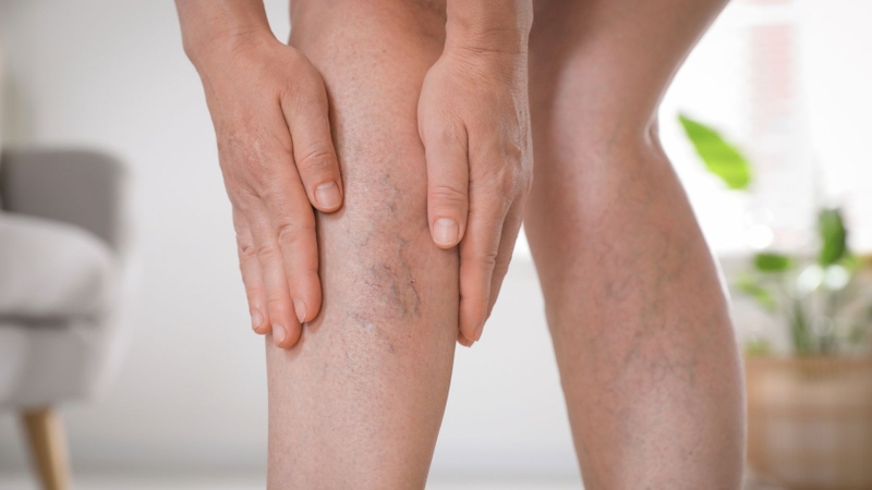 Người bị giãn tĩnh mạch có thể massage nhẹ nếu giãn tĩnh mạch mức độ nhẹ