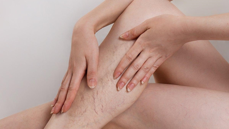 Suy giãn tĩnh mạch là gì? Mách bạn các loại cây thuốc nam chữa suy giãn tĩnh mạch hiệu nghiệm bất ngờ 6