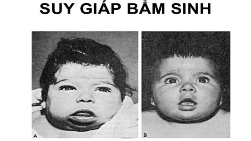 Suy giáp bẩm sinh xảy ra ở các bé sơ sinh khi tuyến giáp không sản xuất đủ lượng hormone cần thiết cho cơ thể.