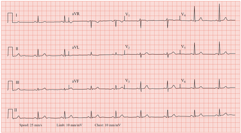 Suy nút xoang tim: Nguyên nhân, chẩn đoán và phương pháp điều trị 3
