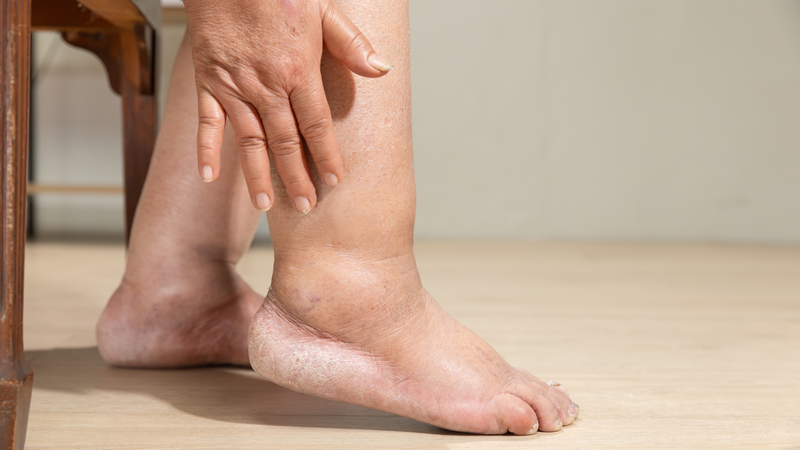 Suy tim có thể gây ra phù chân và khó thở, lâu dần có thể tiến triển thành suy thận
