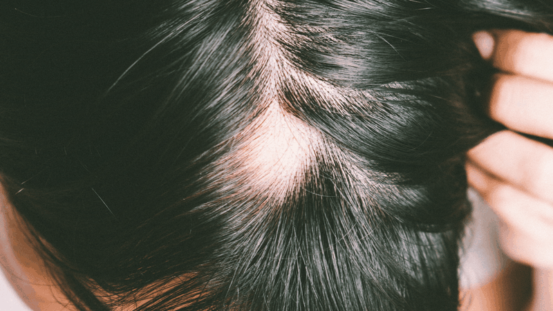 Tóc rụng nhiều là một trong những triệu chứng thường gặp ở bệnh suy tuyến cận giáp