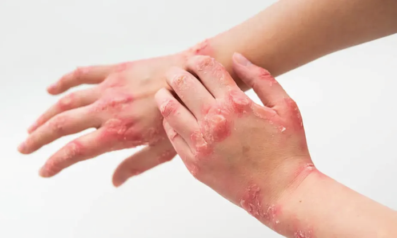 Tác động của các yếu tố tâm lý đối với bệnh viêm khớp vảy nến 1