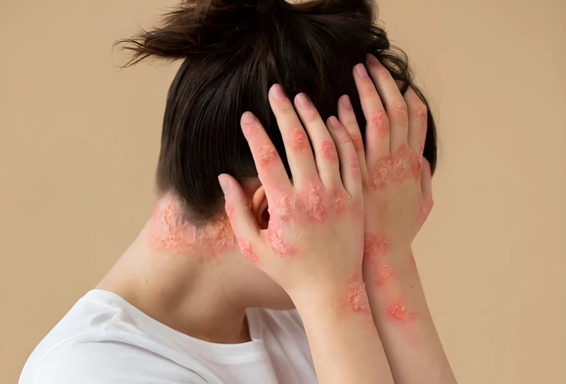 Tác động của các yếu tố tâm lý đối với bệnh viêm khớp vảy nến 2