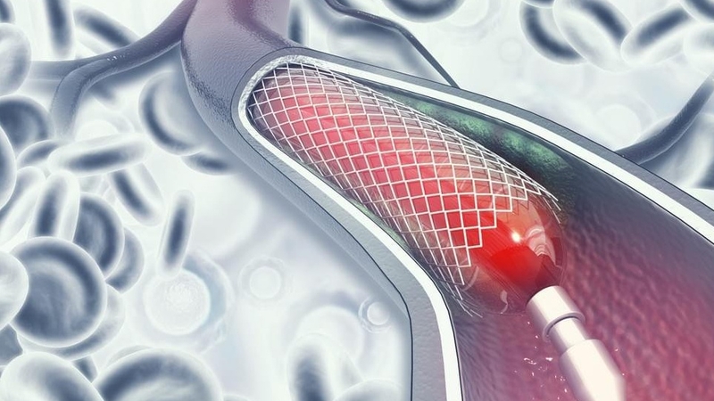 Tắc động mạch chủ: Nguyên nhân. chẩn đoán và cách chữa trị 3