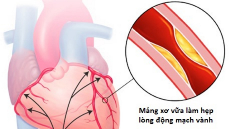 tac-dong-mach-vanh-nguyen-nhan-trieu-chung-va-cach-phong-ngua 2