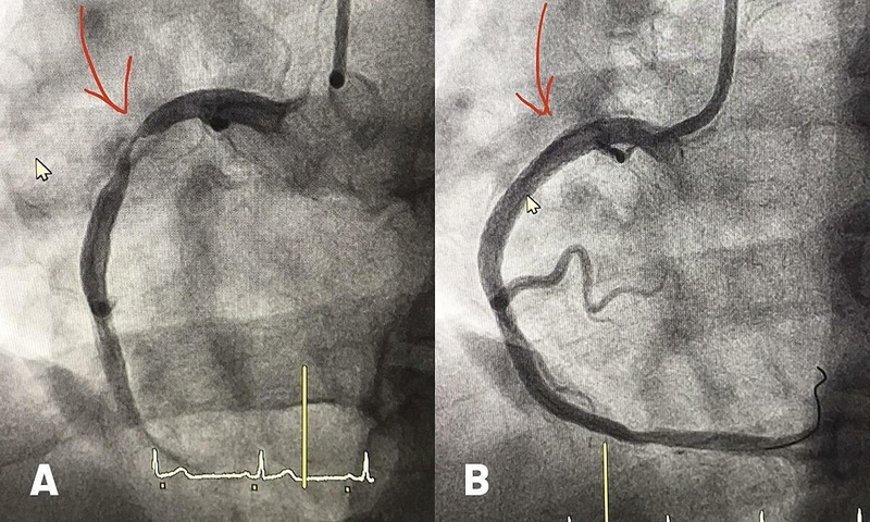 Giải đáp về tác động và độ an toàn của stent phủ thuốc 2