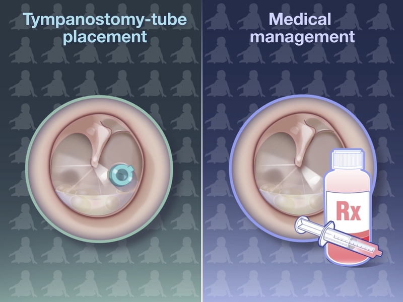 Tác dụng “bất ngờ” của phương pháp đặt ống thông khí màng nhĩ 3